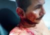 Policía atropelló a líderes campesinos del Putumayo Policía atropelló a líderes campesinos del Putumayo